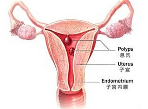 子宫内膜息肉手术前后应考虑的问题